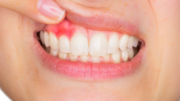 Que es la gingivitis? Que es la gingivitis?